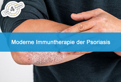 Moderne Immuntherapie der Psoriasis
